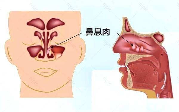 在重庆去哪家医院治疗鼻息肉