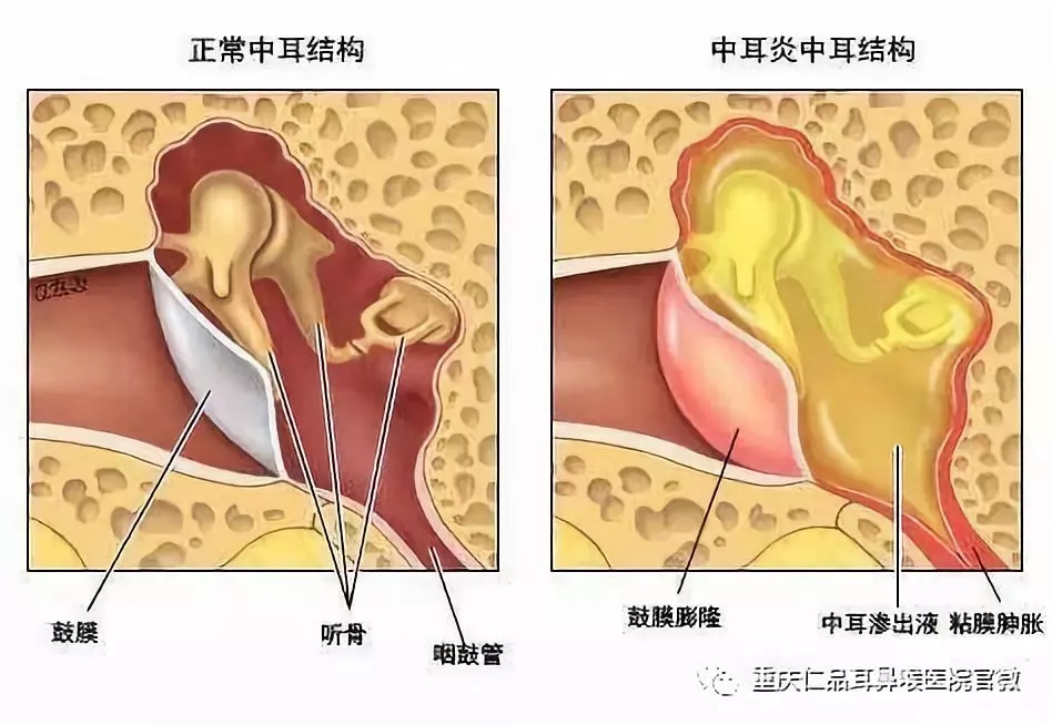 胆脂瘤型中耳炎