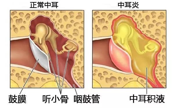 重庆中耳炎有哪几种类型