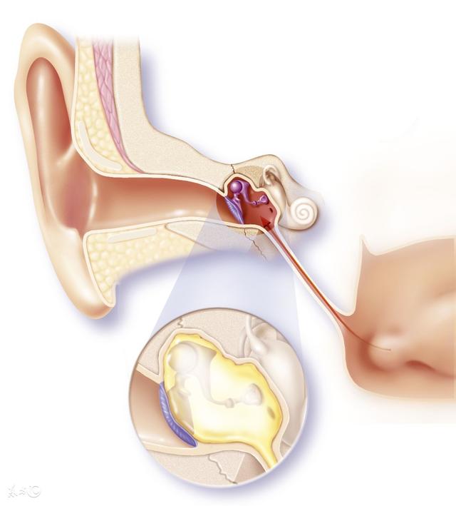 中耳炎引起耳朵流水怎么处理