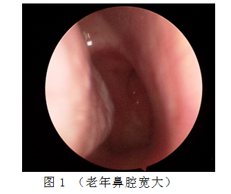 鼻腔宽大