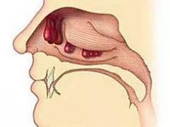 鼻息肉的见症状有哪些？重庆耳鼻喉科医院哪家
