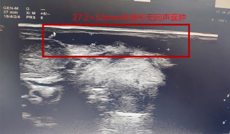 彩超下见长条形无回声结节