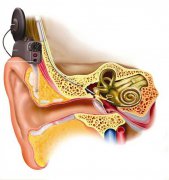 一篇掌握<人工耳蜗>那些事儿