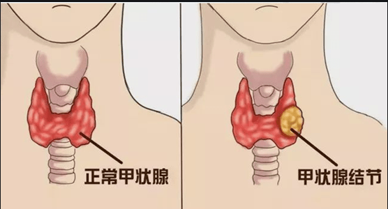 甲状腺结节