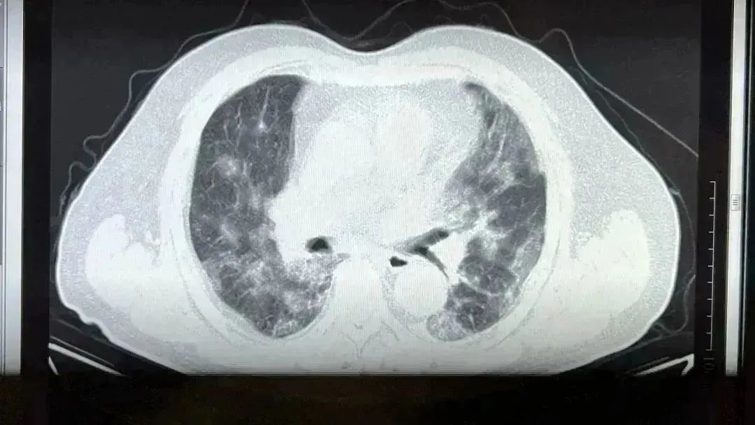重庆肺部CT医院