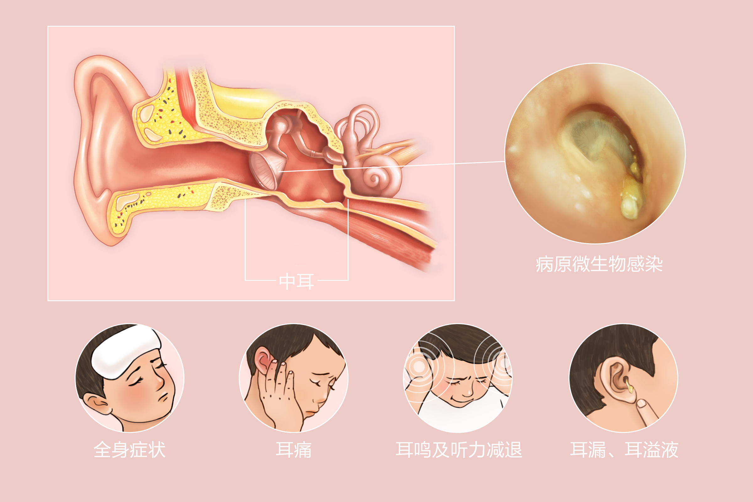 重庆耳鼻喉科医院-中耳炎